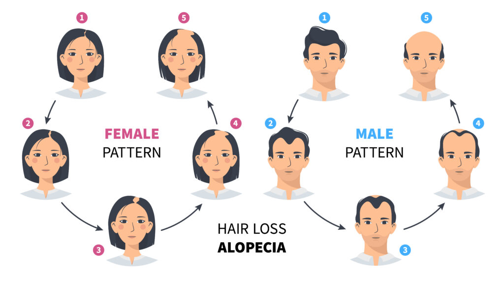 alopecia 07