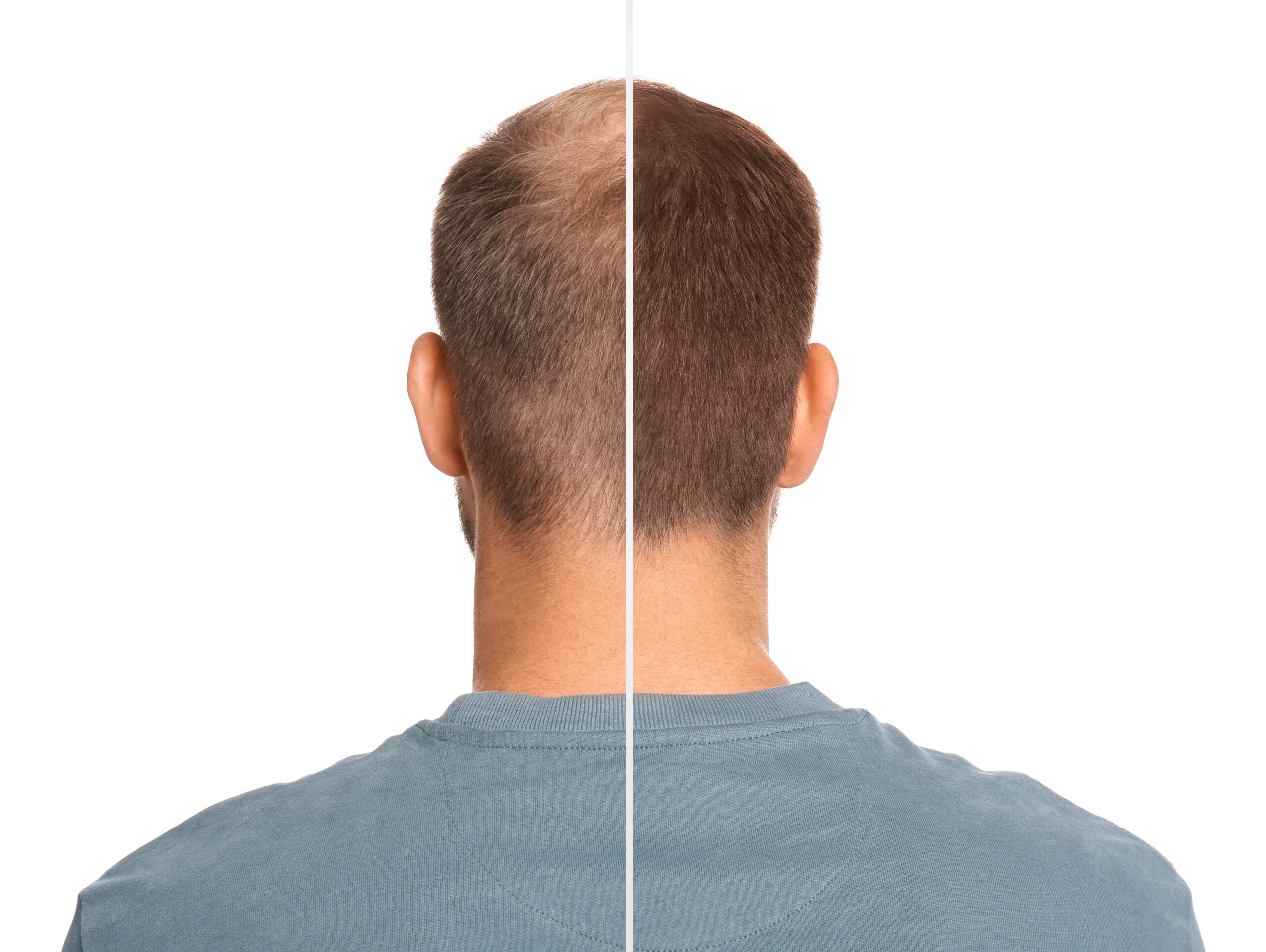 man with hair loss problem before after treatment white background collage visiting trichologist scaled