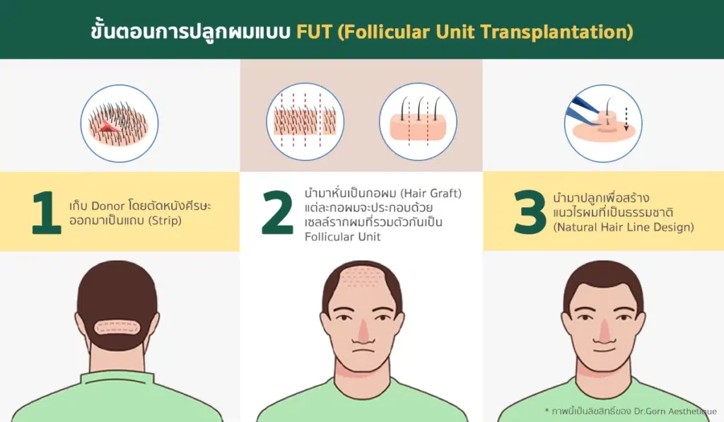 ขั้นตอนการปลูกผมแบบ FUT Follicular Unit Transplantation.jpg